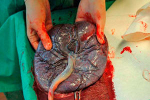 O que acontece com a placenta após o parto?